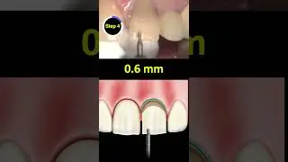 Placing Depth Cuts on the Anterior Tooth: Ep 4 #shorts