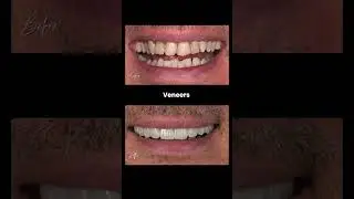 Veneer Smile Makeover at Dr Joy DentaL Clinic  #dentist #smilemakeover  #dentalclinic