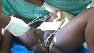 Episiotomy  Repair: Episiotomy and delivery of the baby