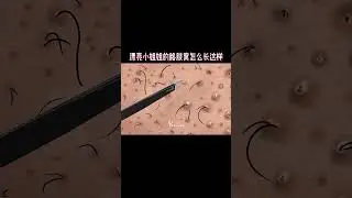 😱ASMR Pimple blackhead and sebaceous cyst removal for gamer | Massage hand - 5gasmr ANIMATION