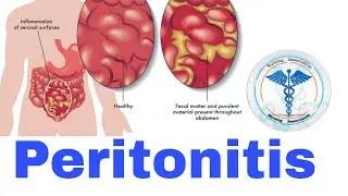 Peritonitis | Nursing Lecture
