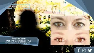 Realself.com patient testimonial (73): Eyelid Surgery, Lip Aug, Lipo, BBL with Dr. Campbell and PCPS