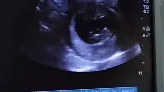 10 Weeks Ultrasound | TheCramers