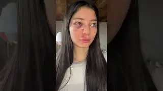 Ich mache den Trend nochmal wenn mein Gesicht geheilt ist😭