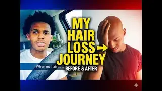 Going Bald at 22!?! - My Hair Loss. Should you shave?