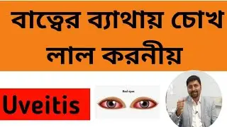 Uveitis. ইউভিয়াইটিস ও লাল চোখ। Dr Mominul Islam