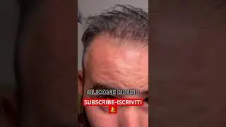 CADUTA CAPELLI #hairloss #cadutacapelli #hairlosstreatment #calvo #calvizie #baldness #funnyshorts