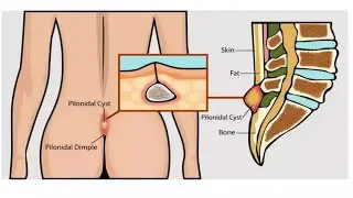 Pilonidal Sinus Ultrasound