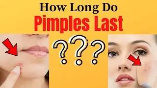 How Long Do Pimples Last?