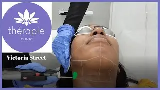 Th&eacute;rapie Clinic - Chin laser hair removal on black skin