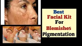 Best Facial For Blemishes |Top 5 Facial For Pigmentation  #facialkit