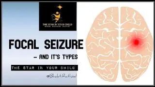 FOCAL SEIZURE #focalseizure #specialneedsparenting #empoweryourself #epilepsy #seizure