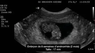Embryon 8 semaines de grossesse