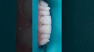 ☝️COMO S&Atilde;O FEITO AS FACETAS EM RESINAS! #facetasdentarias #dentista