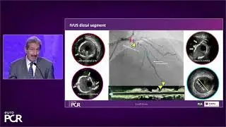 EuroPCR 2023 Case in Point: More Pulses to Take You Further Across All Calcium Morphologies