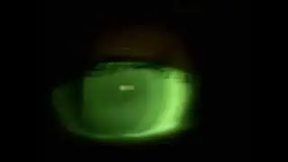 Fitting a piggyback system with a spherical rigid lens and PureVision 2 soft lens