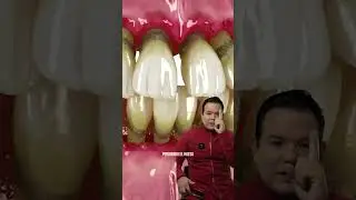 Enfermedad periodontal cu&aacute;l es la soluci&oacute;n?