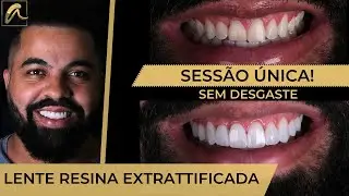 LENTES DE RESINA EM UMA SESSÃO!