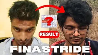 Thinking of Using Finasteride? Watch This First