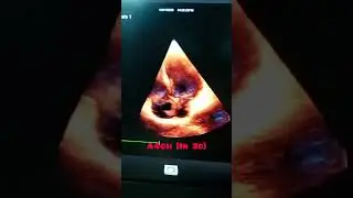 &ldquo;Four‑chamber flash!Echo window unlocked &ndash; LA, LV, RA, RV all in sync.