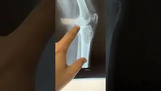 Jorni ko cancer ?? #doctor #pain #cancer 