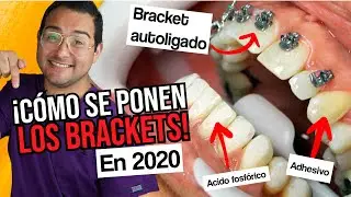 CÓMO SE PONEN LOS BRACKETS en los DIENTES EN 2020 - ¡INSTALACIÓN  DE ORTODONCIA AUTOLIGADO!