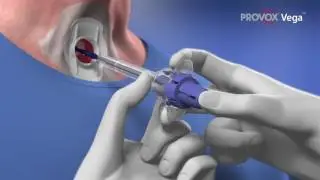 ProvoxVegaInsertion EN