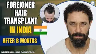 Foreigner hair transplant in India | @kyle_paul Reacts on hair transplant | Hairfree And Hairgrow