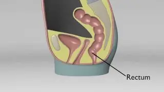 Rectocele No Uterus