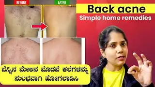 Back acne treatment home remedies | ಬೆನ್ನಿನ ಮೊಡವೆ ಕಲೆಗಳನ್ನು ಸುಲಭವಾಗಿ ಹೋಗಲಾಡಿಸಿ | Skin care Tips