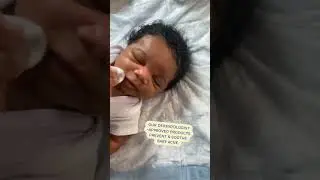 Treating #babyacne