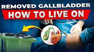Post–gallbladder removal recovery algorithm — the 3 essential rules you must follow