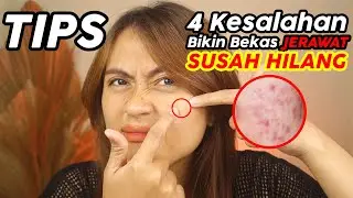 4 Kesalahan yang bikin JERAWAT SUSAH HILANG | Risa Florendo