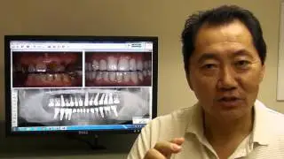 Full Mouth Cosmetic Implant Dentistry, Tijuana, Mexico