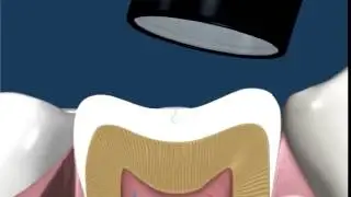 Dental Sealants 1