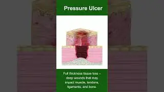 How Pressure Ulcers Progress: Stage 1 to Stage 4