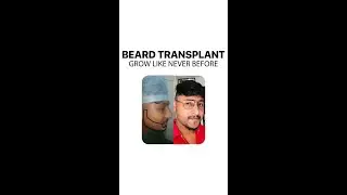 Beard Transplant - Max Hair Clinic