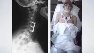 Shield HealthCare Webinar: Road to Recovery-Life After Spinal Cord Injury