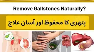 Gallstones Treatment Without Surgery | Homeopathy for Safe Gallbladder Stone Removal