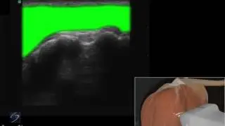 Guide 3D: Esame ecografico del tendine del bicipite - Sistema a ultrasuoni SonoSite