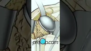 PreOp&reg; What to Expect: Open Shoulder Replacement! 🔍 #preop #shorts #health 🏥