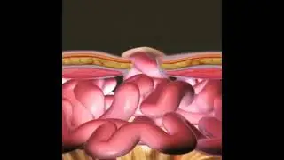 Hernia Repair - Surgical Operation of a hernia
