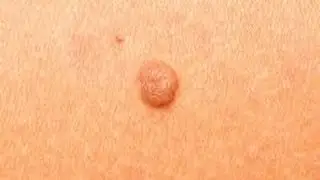 How to Remove Skin Tags at Home [DermTV.com Epi #511]