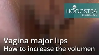 Vagina major lips - How to increase the volumen (22075)