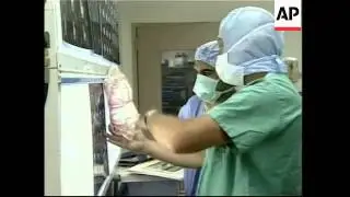 Hospital releases video of conjoined Filipino twins