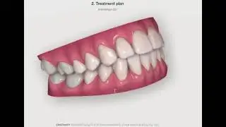 Invisalign GO Treatment Plan with Dr Mo Soliman | Kelmscott Dental