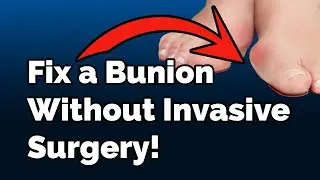 Fix a Bunion Without Bunion Surgery? Yes&mdash;Here&rsquo;s How.