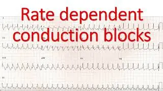 Rate dependent conduction blocks
