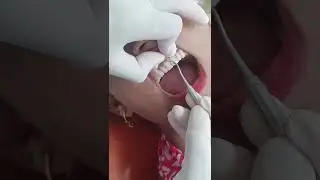 &ldquo;Front Teeth Cavity Treatment .दांतों के रंग की फिलिंग Composite Resin Filling.Real Dental case. 