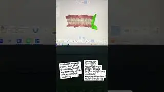 Medit- Occlusion Analysis